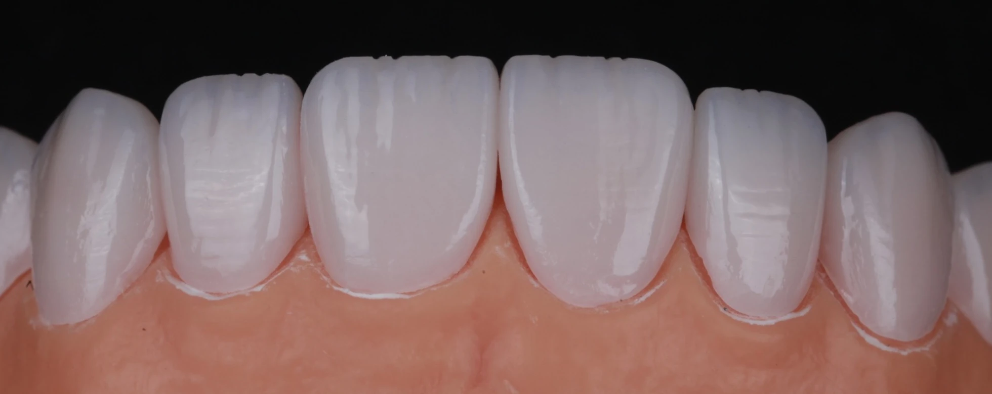 Close-up of hand-layered Halo porcelain veneers on the model